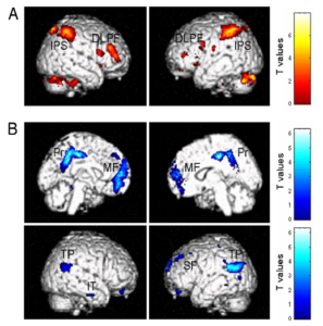 Imágenes del cerebro: Correlatos neuronales de la consciencia de estímulos somatosensoriales.:left