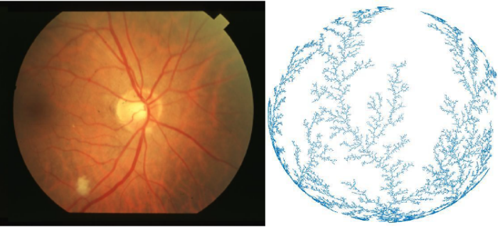 Izquierda: Imagen de la retina humana y del árbol circulatorio. Derecha: estructura fractal creada por computadora por Irurzun y colaboradores.